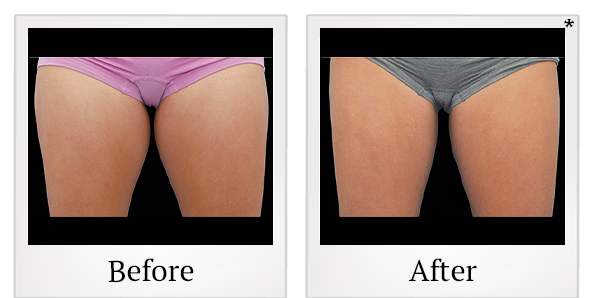 Before and After Photo 2 of Coolsculpting® treatment at SF Bay Cosmetic Surgery Medical Group in San Ramon