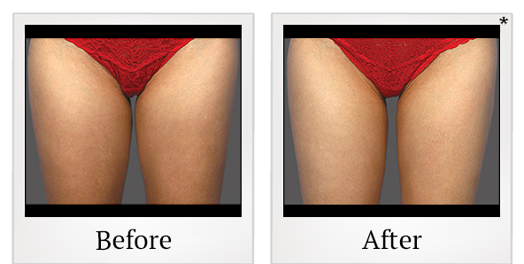 Before and After Photo 3 of Coolsculpting® treatment at SF Bay Cosmetic Surgery Medical Group in San Ramon