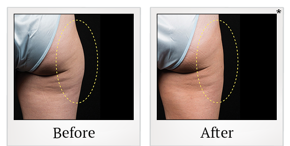 Before and After Photo 4 of Coolsculpting® treatment at SF Bay Cosmetic Surgery Medical Group in San Ramon