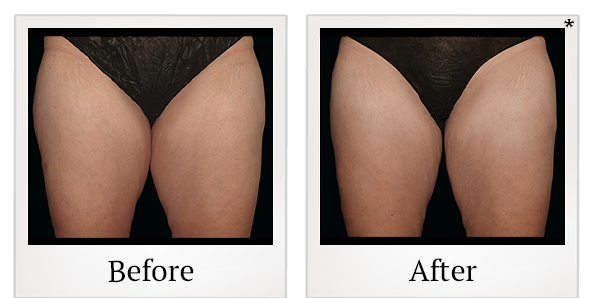 Before and After Photo 5 of Coolsculpting® treatment at SF Bay Cosmetic Surgery Medical Group in San Ramon