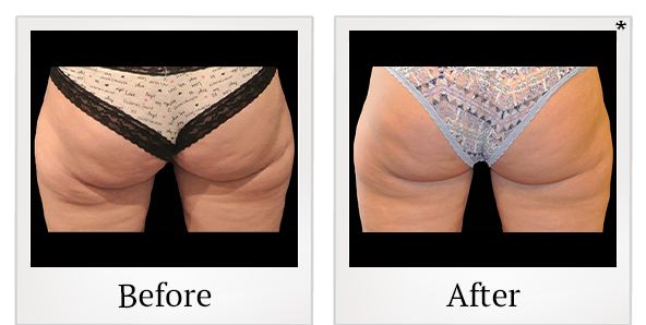 Before and After Photo 6 of Coolsculpting® treatment at SF Bay Cosmetic Surgery Medical Group in San Ramon