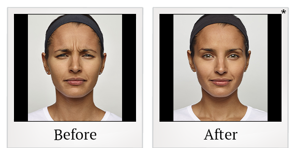 Before and After Photo 1 of Dysport® treatment at SF Bay Cosmetic Surgery Medical Group in San Ramon