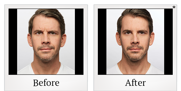 Before and After Photo 10 of Dysport® treatment at SF Bay Cosmetic Surgery Medical Group in San Ramon
