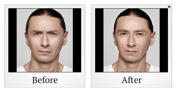 Before and After Photo 11 of Dysport® treatment at SF Bay Cosmetic Surgery Medical Group in San Ramon