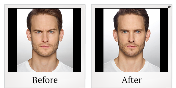 Before and After Photo 12 of Dysport® treatment at SF Bay Cosmetic Surgery Medical Group in San Ramon