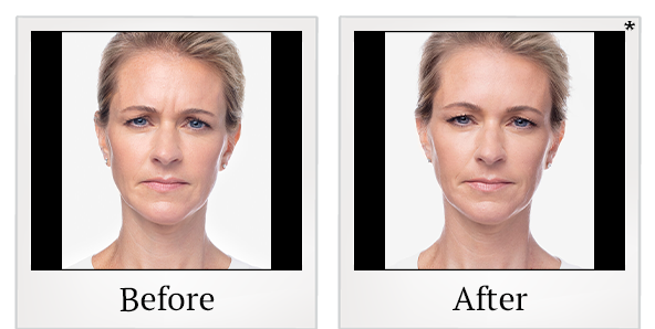 Before and After Photo 13 of Dysport® treatment at SF Bay Cosmetic Surgery Medical Group in San Ramon