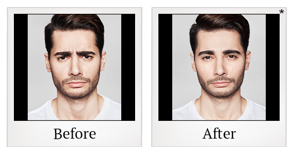 Before and After Photo 14 of Dysport® treatment at SF Bay Cosmetic Surgery Medical Group in San Ramon