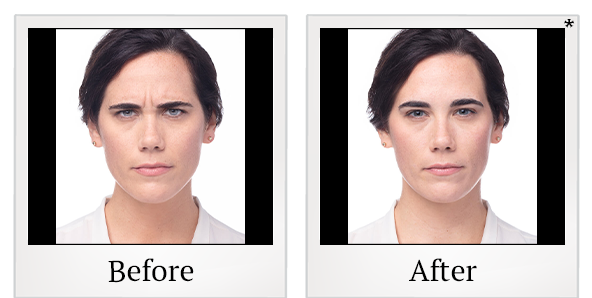 Before and After Photo 15 of Dysport® treatment at SF Bay Cosmetic Surgery Medical Group in San Ramon