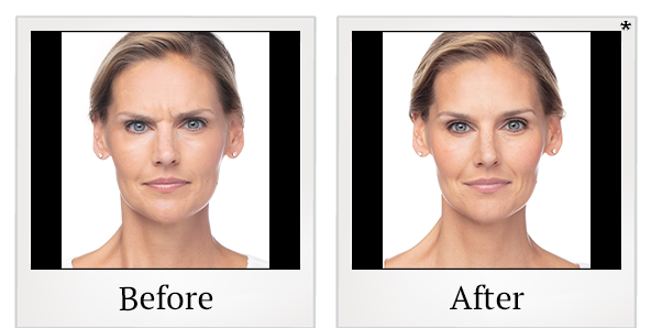 Before and After Photo 16 of Dysport® treatment at SF Bay Cosmetic Surgery Medical Group in San Ramon