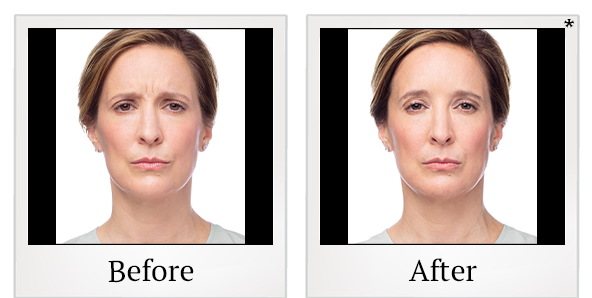 Before and After Photo 17 of Dysport® treatment at SF Bay Cosmetic Surgery Medical Group in San Ramon