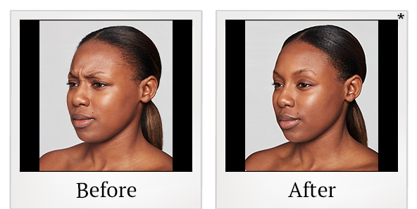 Before and After Photo 18 of Dysport® treatment at SF Bay Cosmetic Surgery Medical Group in San Ramon