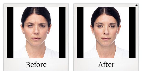Before and After Photo 19 of Dysport® treatment at SF Bay Cosmetic Surgery Medical Group in San Ramon