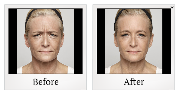 Before and After Photo 2 of Dysport® treatment at SF Bay Cosmetic Surgery Medical Group in San Ramon