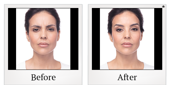 Before and After Photo 20 of Dysport® treatment at SF Bay Cosmetic Surgery Medical Group in San Ramon