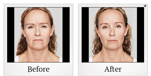 Before and After Photo 21 of Dysport® treatment at SF Bay Cosmetic Surgery Medical Group in San Ramon