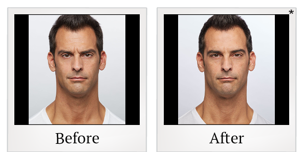 Before and After Photo 3 of Dysport® treatment at SF Bay Cosmetic Surgery Medical Group in San Ramon