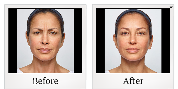 Before and After Photo 4 of Dysport® treatment at SF Bay Cosmetic Surgery Medical Group in San Ramon