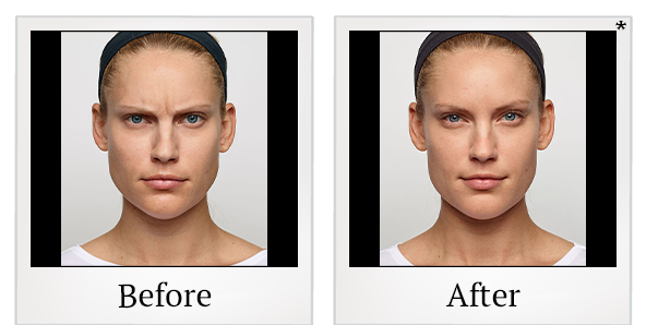 Before and After Photo 5 of Dysport® treatment at SF Bay Cosmetic Surgery Medical Group in San Ramon