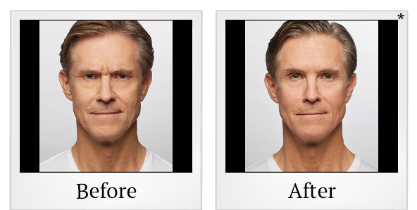 Before and After Photo 6 of Dysport® treatment at SF Bay Cosmetic Surgery Medical Group in San Ramon