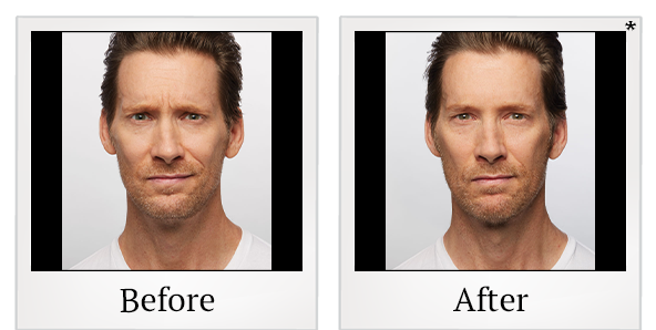 Before and After Photo 7 of Dysport® treatment at SF Bay Cosmetic Surgery Medical Group in San Ramon