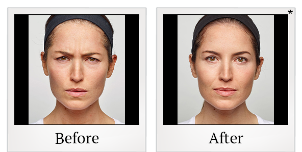 Before and After Photo 8 of Dysport® treatment at SF Bay Cosmetic Surgery Medical Group in San Ramon
