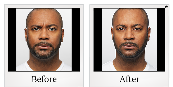 Before and After Photo 9 of Dysport® treatment at SF Bay Cosmetic Surgery Medical Group in San Ramon