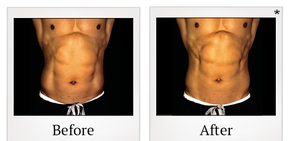 Before and After Photo 1 of Emsculpt® treatment at SF Bay Cosmetic Surgery Medical Group in San Ramon