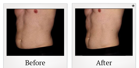 Before and After Photo 10 of Emsculpt® treatment at SF Bay Cosmetic Surgery Medical Group in San Ramon