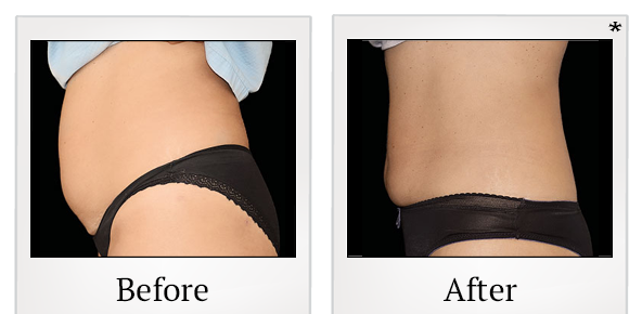 Before and After Photo 11 of Emsculpt® treatment at SF Bay Cosmetic Surgery Medical Group in San Ramon