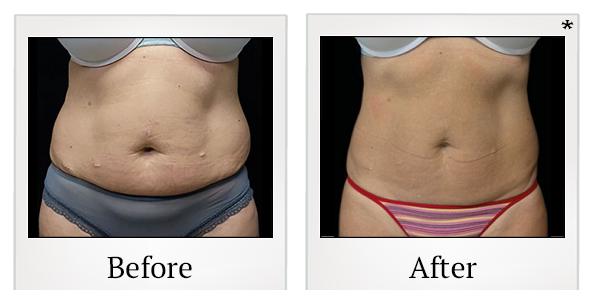 Before and After Photo 12 of Emsculpt® treatment at SF Bay Cosmetic Surgery Medical Group in San Ramon
