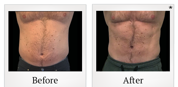 Before and After Photo 13 of Emsculpt® treatment at SF Bay Cosmetic Surgery Medical Group in San Ramon