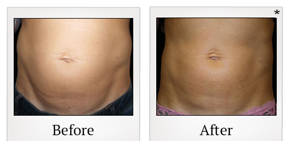 Before and After Photo 14 of Emsculpt® treatment at SF Bay Cosmetic Surgery Medical Group in San Ramon