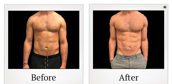 Before and After Photo 15 of Emsculpt® treatment at SF Bay Cosmetic Surgery Medical Group in San Ramon