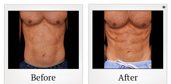 Before and After Photo 16 of Emsculpt® treatment at SF Bay Cosmetic Surgery Medical Group in San Ramon