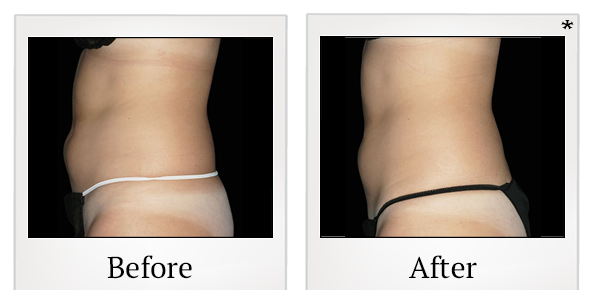 Before and After Photo 17 of Emsculpt® treatment at SF Bay Cosmetic Surgery Medical Group in San Ramon