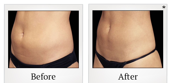 Before and After Photo 18 of Emsculpt® treatment at SF Bay Cosmetic Surgery Medical Group in San Ramon