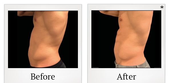 Before and After Photo 19 of Emsculpt® treatment at SF Bay Cosmetic Surgery Medical Group in San Ramon