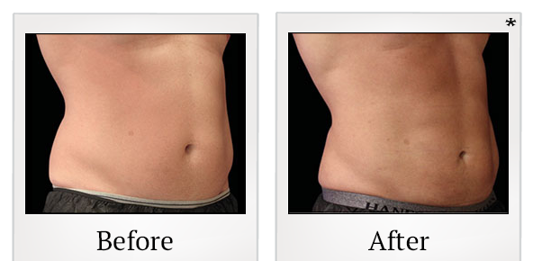 Before and After Photo 2 of Emsculpt® treatment at SF Bay Cosmetic Surgery Medical Group in San Ramon