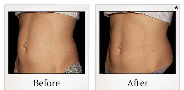 Before and After Photo 20 of Emsculpt® treatment at SF Bay Cosmetic Surgery Medical Group in San Ramon