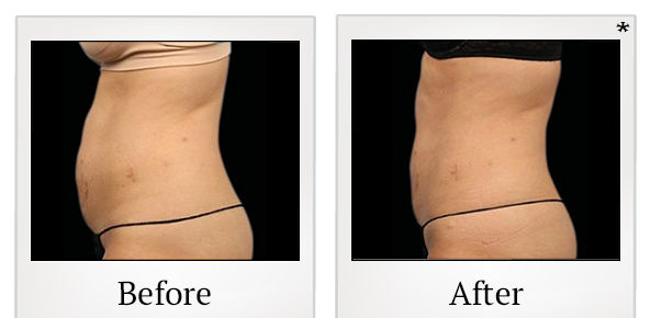 Before and After Photo 21 of Emsculpt® treatment at SF Bay Cosmetic Surgery Medical Group in San Ramon