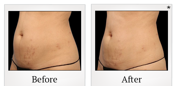 Before and After Photo 22 of Emsculpt® treatment at SF Bay Cosmetic Surgery Medical Group in San Ramon