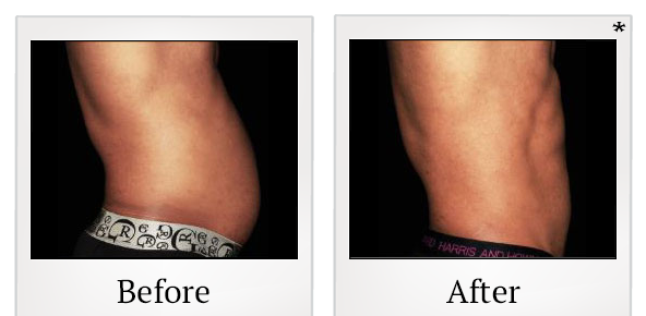 Before and After Photo 23 of Emsculpt® treatment at SF Bay Cosmetic Surgery Medical Group in San Ramon