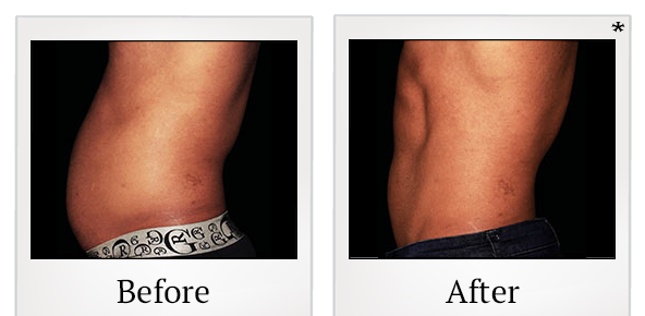 Before and After Photo 24 of Emsculpt® treatment at SF Bay Cosmetic Surgery Medical Group in San Ramon