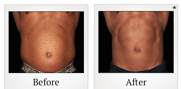 Before and After Photo 25 of Emsculpt® treatment at SF Bay Cosmetic Surgery Medical Group in San Ramon