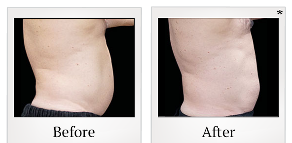 Before and After Photo 26 of Emsculpt® treatment at SF Bay Cosmetic Surgery Medical Group in San Ramon