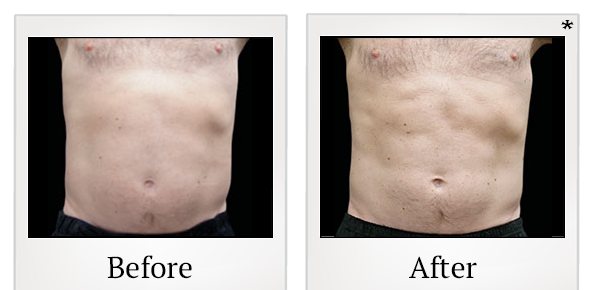Before and After Photo 27 of Emsculpt® treatment at SF Bay Cosmetic Surgery Medical Group in San Ramon