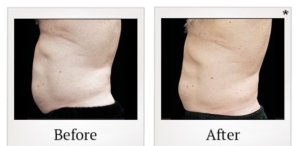Before and After Photo 28 of Emsculpt® treatment at SF Bay Cosmetic Surgery Medical Group in San Ramon