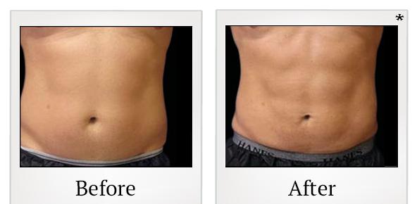 Before and After Photo 29 of Emsculpt® treatment at SF Bay Cosmetic Surgery Medical Group in San Ramon