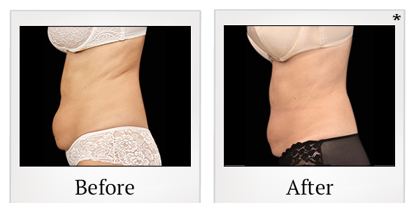 Before and After Photo 3 of Emsculpt® treatment at SF Bay Cosmetic Surgery Medical Group in San Ramon