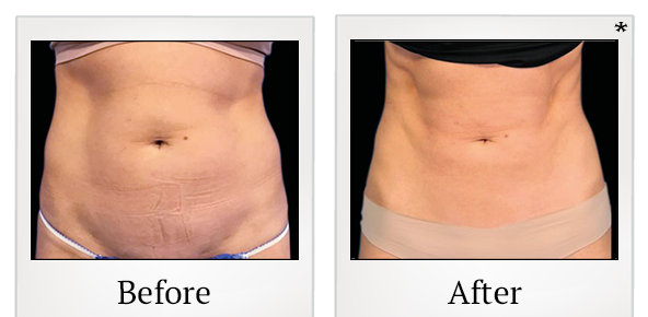 Before and After Photo 30 of Emsculpt® treatment at SF Bay Cosmetic Surgery Medical Group in San Ramon